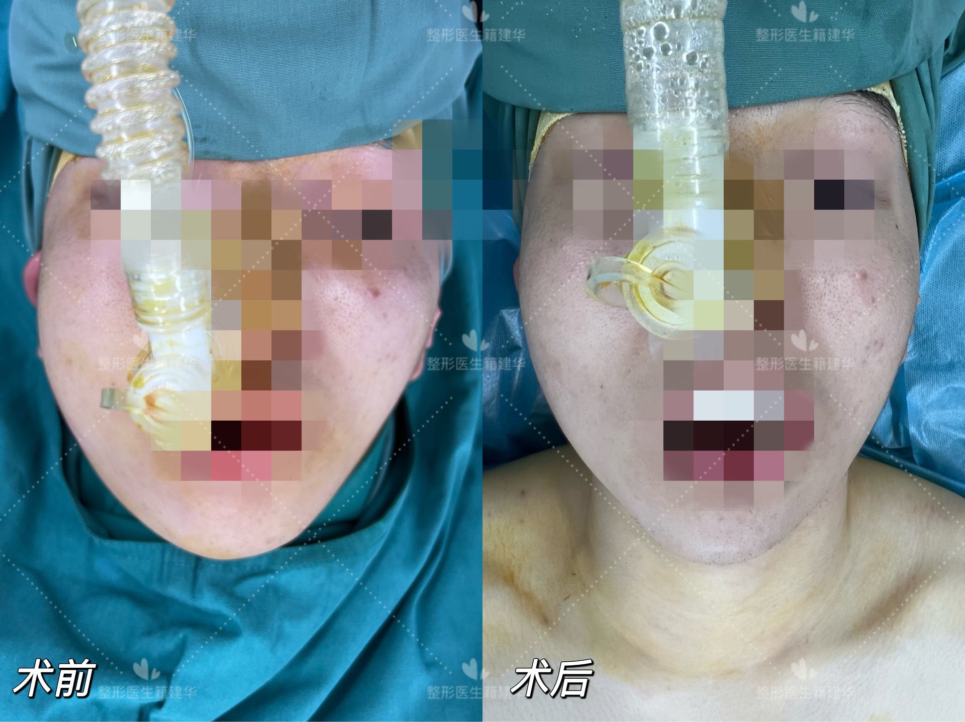 半侧颜面短小症是什么原因导致的,半侧颜面畸形如何改善