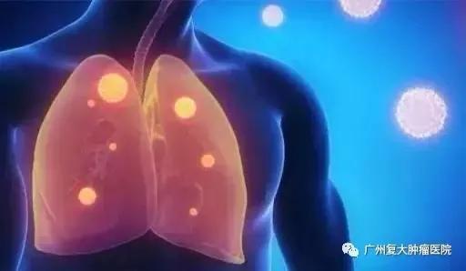 肺结节该观察还是手术？或许微创消融治疗是个不错的选择