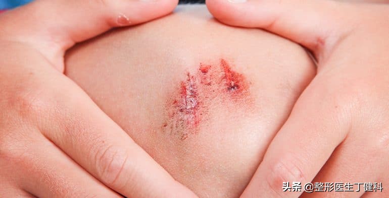 擦伤皮肤疤痕怎么能彻底消除,皮肤擦伤常见处理方法