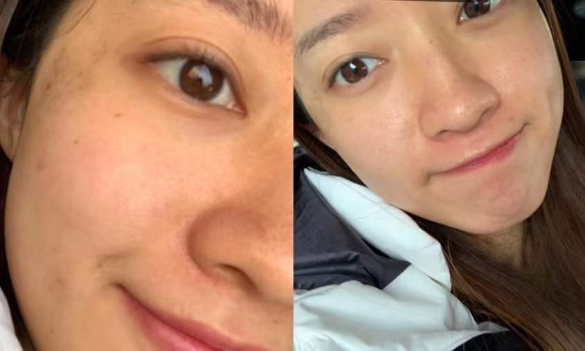 缩小毛孔做水光还是点阵,小姐姐直播说收缩毛孔