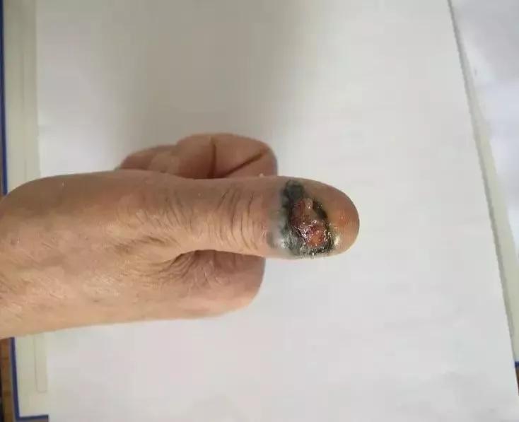 指甲出现黑线是什么病,指甲出现黑线怎么治疗