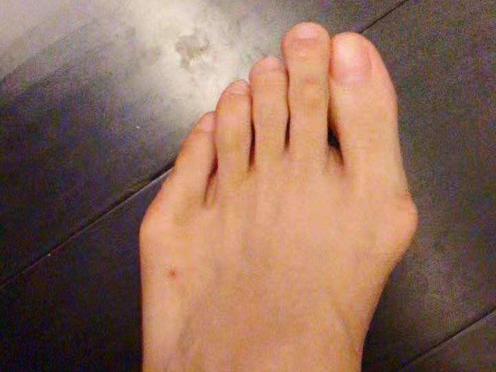 小脚趾外侧凸起怎么办？裁缝趾的手术矫正
