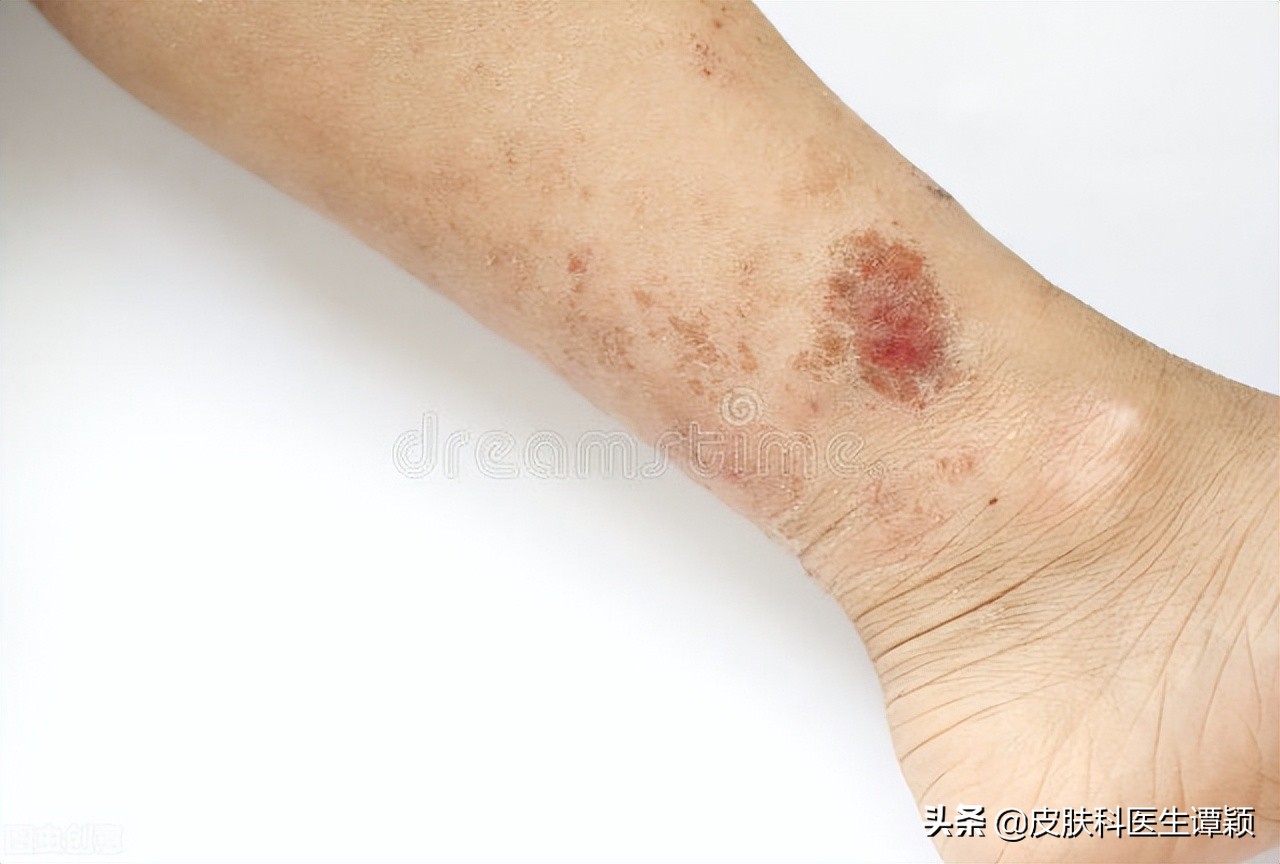 皮肤科医生痱子和湿疹的区别,皮肤科医生如何诊断你是湿疹