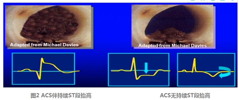 急性胸痛的诊断思路,胸痛知识总结