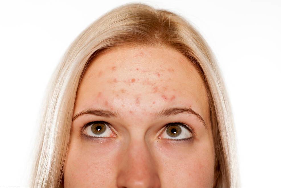 痘痘在脸上哪些位置代表什么,痘痘长在脸上不同位置代表什么