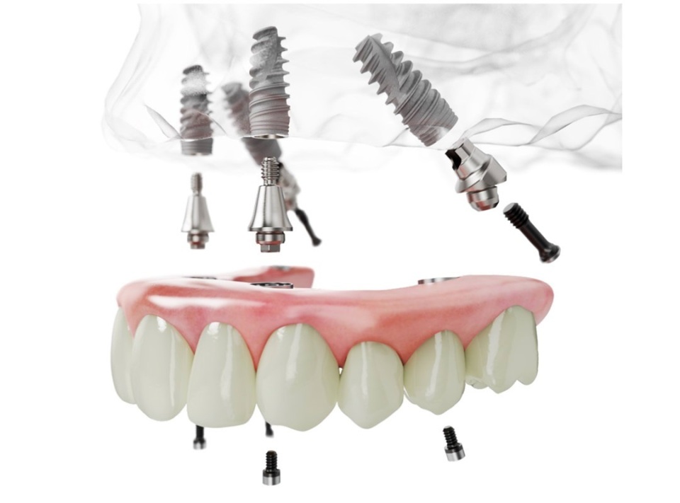 瑞士诺贝尔高端种植牙,诺贝尔金致植体奥齿泰
