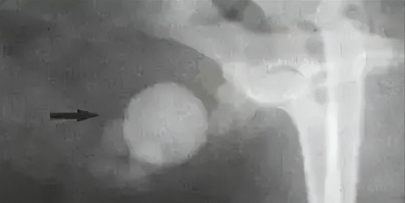 狗狗泌尿结石吃什么药好,狗狗尿路结石保守治疗