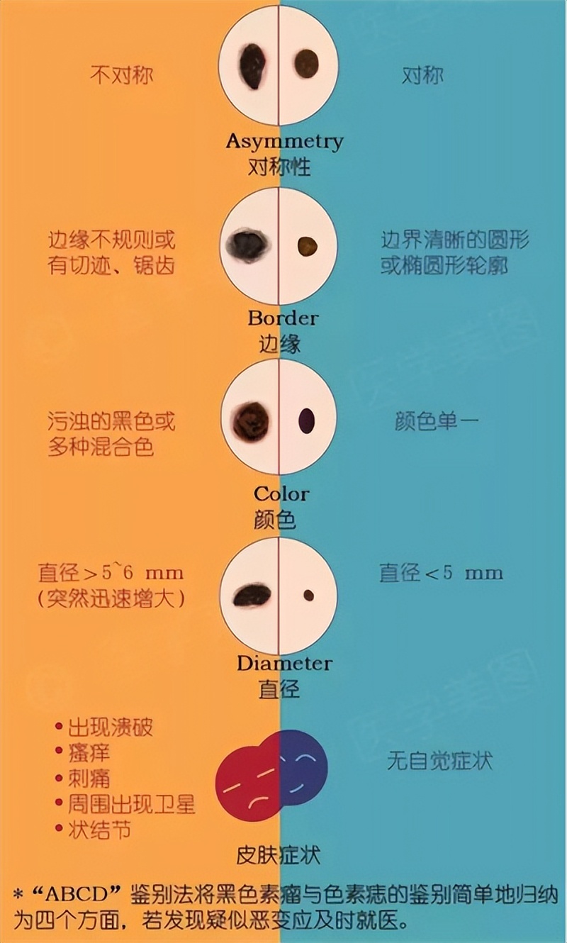 脸上的痣用激光点可以完全去除吗,脸上有痣激光去痣好还是药水点好