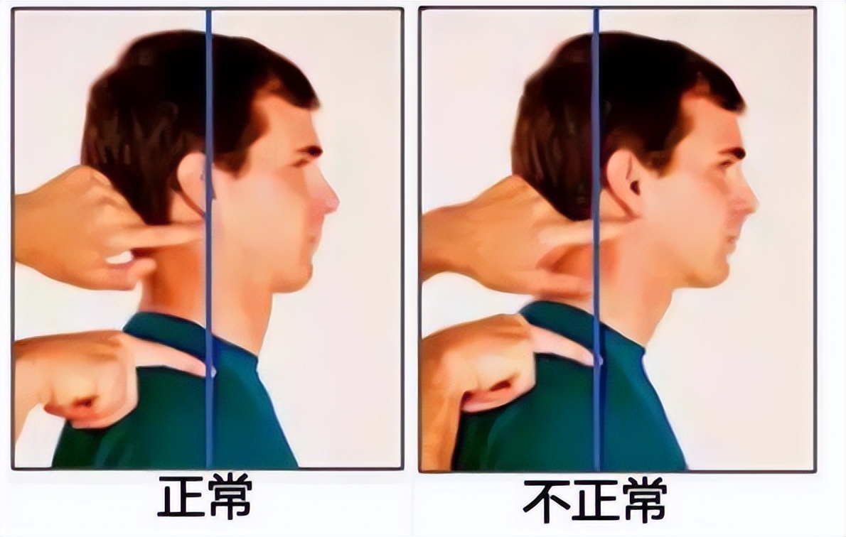 颈复康治疗颈源性头痛吗,颈源性头痛整体解决方案