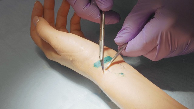 伤口缝合留疤还是不缝合留疤,可吸收的缝合线有疤痕吗