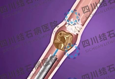 肾结石是不是经常发作,肾结石有石头不痛要治吗