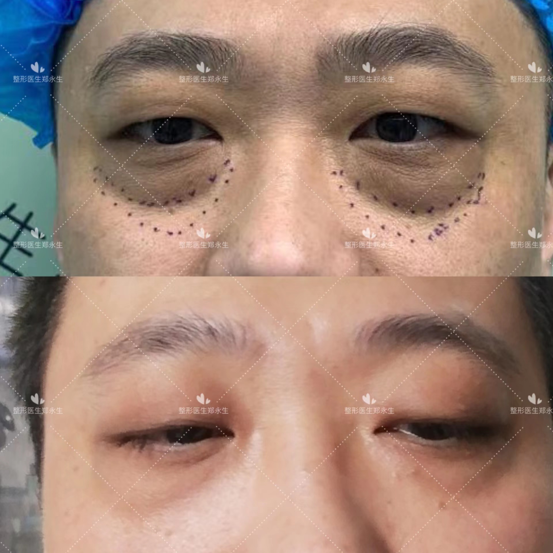 眼袋纹是怎么形成的原因,眼袋的形成原因及消除方法