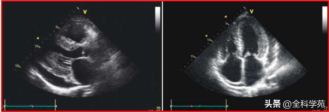 心电图qrs时限超宽是什么引起的,心电图qrs波呈m型见于什么疾病