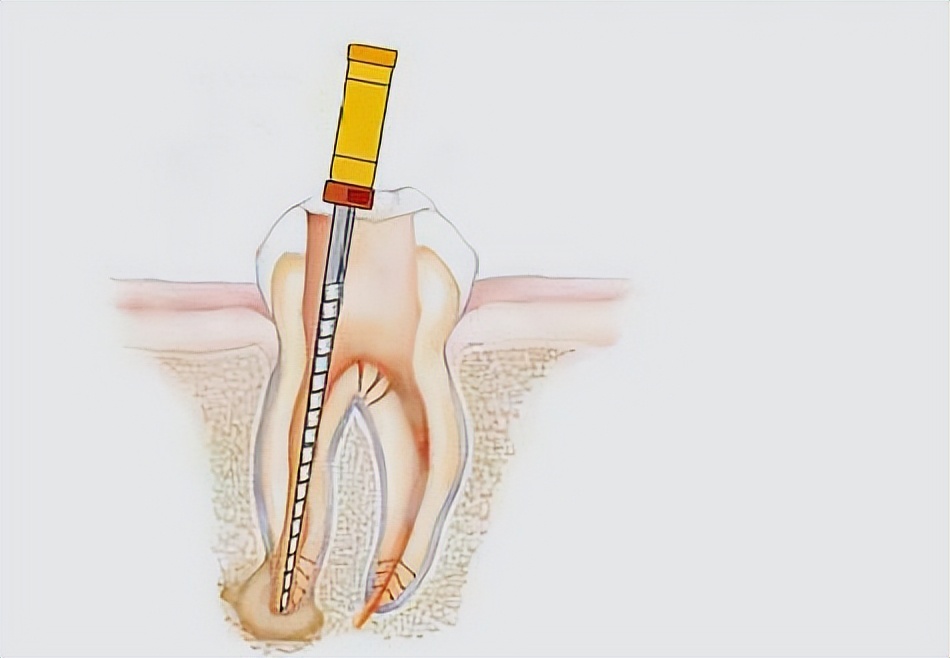 小孩做根管治疗断针,做根管治疗牙根会断吗