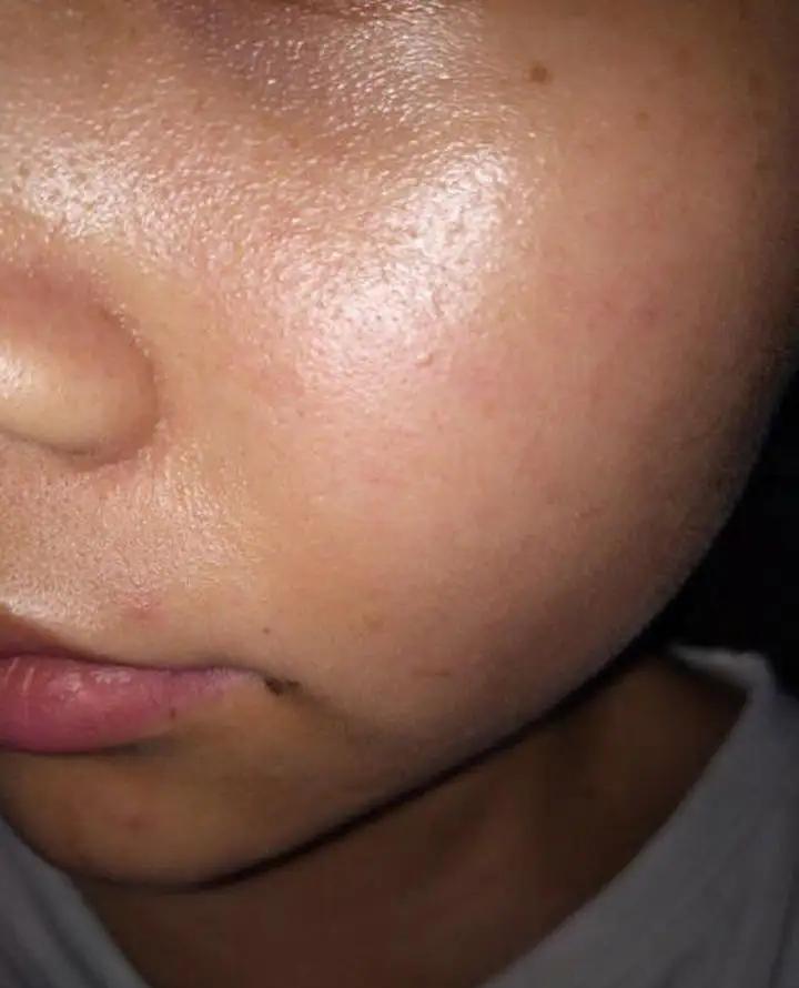 皮肤出油爱长痘怎么解决,皮肤出油长痘暗沉毛孔粗大有粉刺