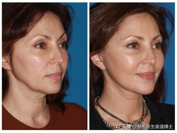 新手医生做拉皮手术可靠吗,北京八大处拉皮手术费多少钱