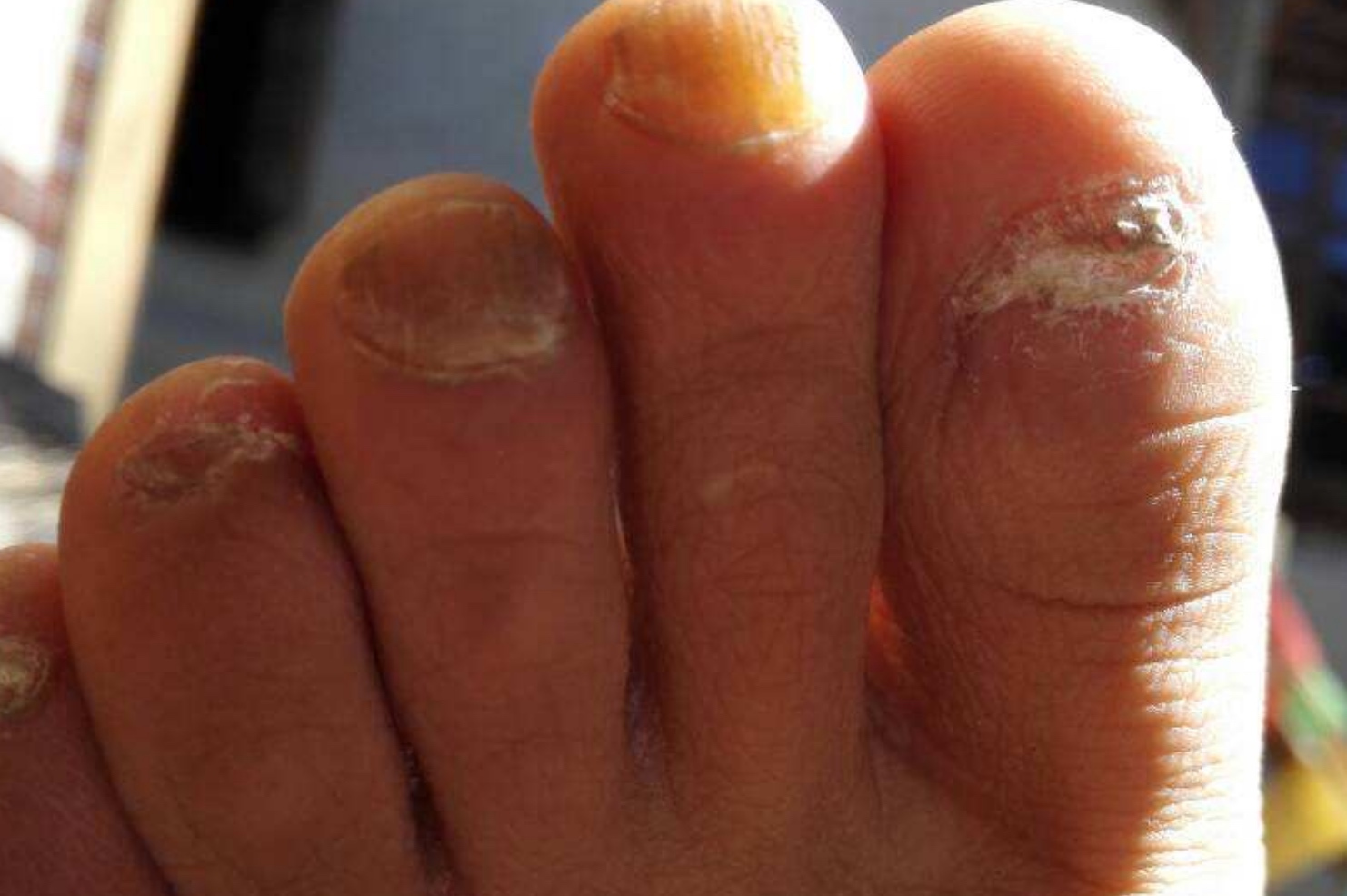 手把手教你如何治疗灰指甲,得了灰指甲去亮甲服务治疗行吗