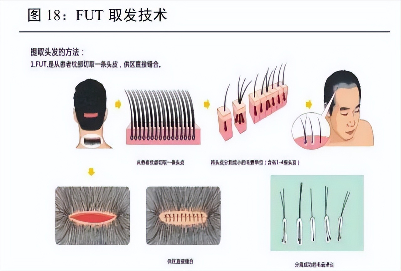 「秃」如起来的90后，把大麦植发顶进港交所？|港股观察站