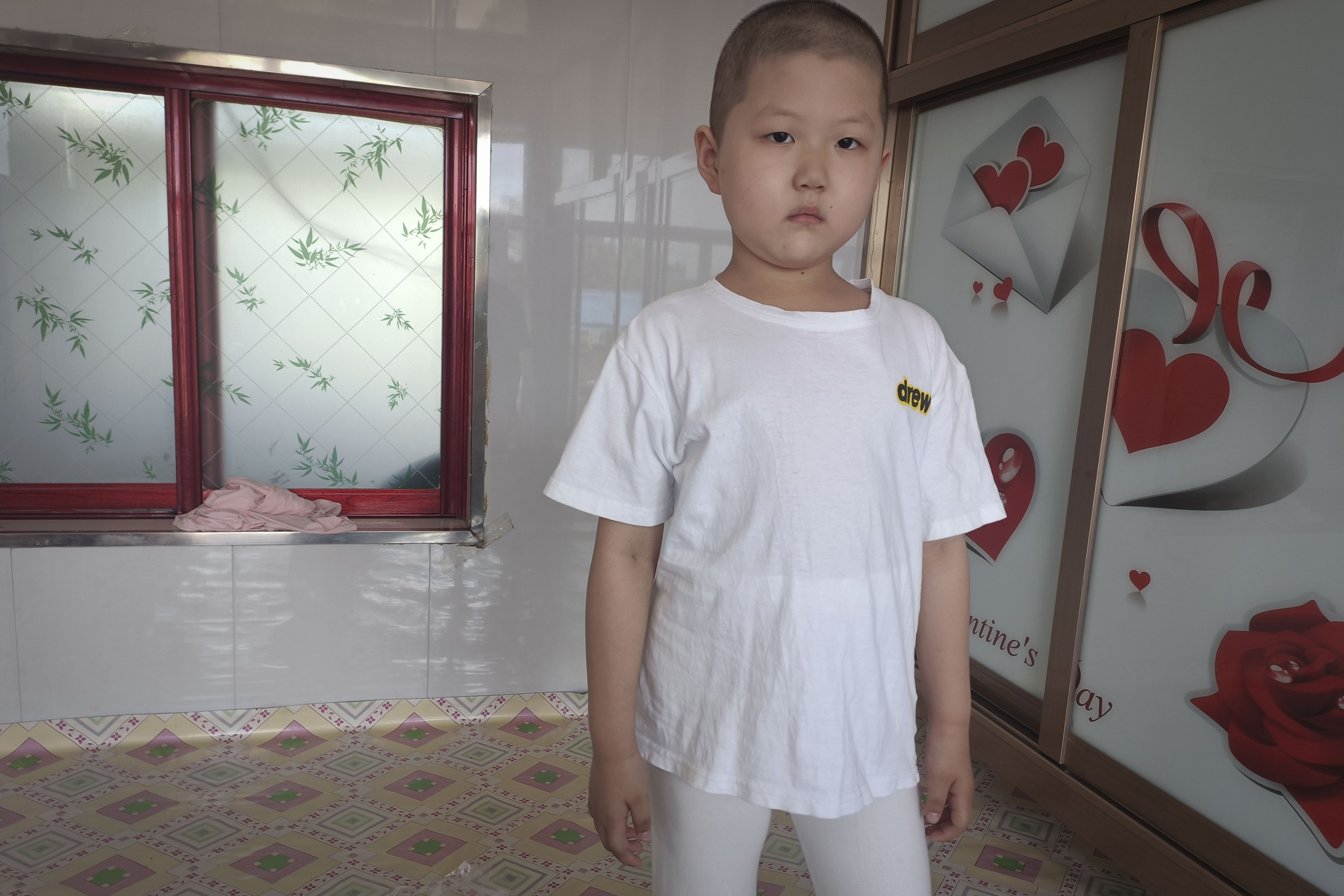 五岁女儿手指肿是怎么回事,五岁女儿手疼