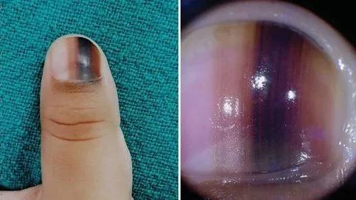 指甲出现黑线是什么病,指甲出现黑线怎么治疗