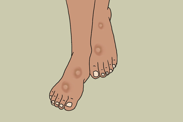 警惕脚部发出的衰老信号,女人脚部衰老的征兆四大表现