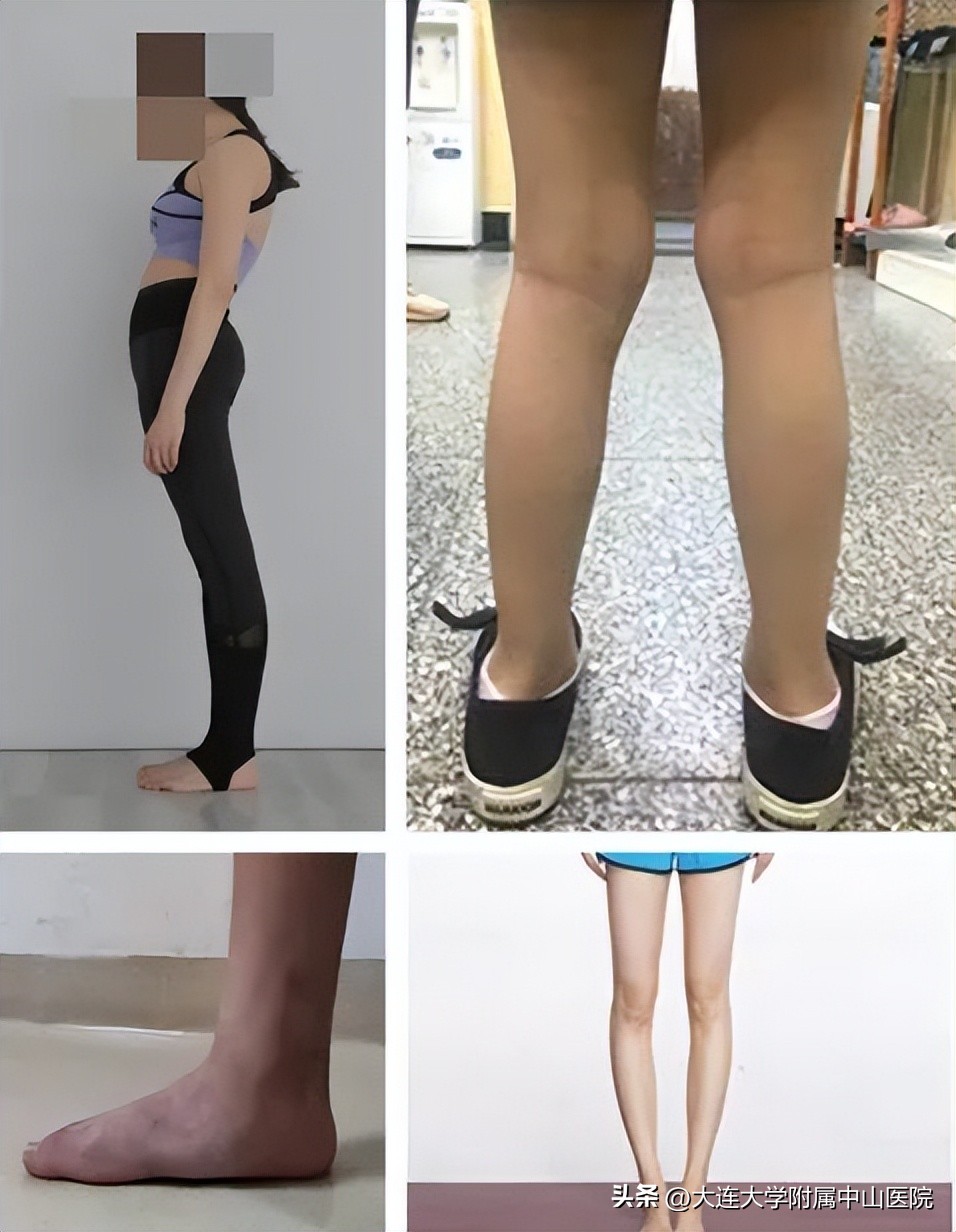 脊柱侧弯康复训练直播回放,脊柱侧弯体态矫正封闭训练营