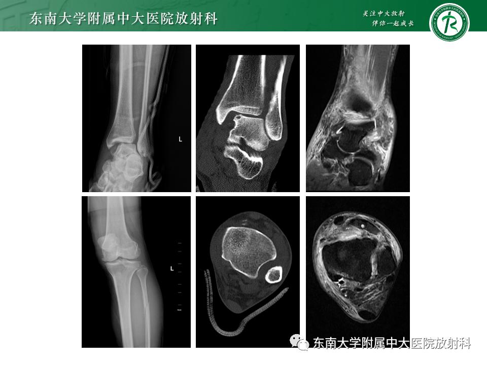 左腓骨下段骨折伴下胫腓联合分离,好文分享深度揭秘