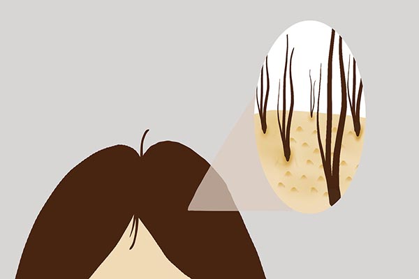 头皮总是出油有味道,头皮老是出油还有痘痘是什么原因