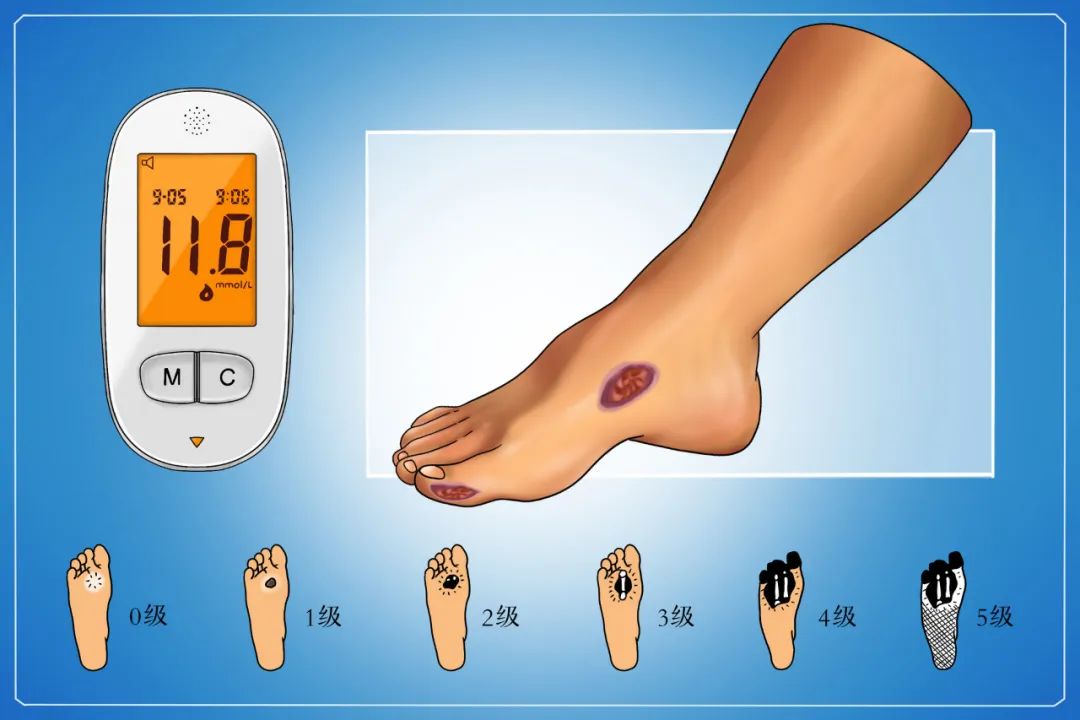 糖尿病足早期如何逆转,康健锦囊专家提醒糖尿病患者