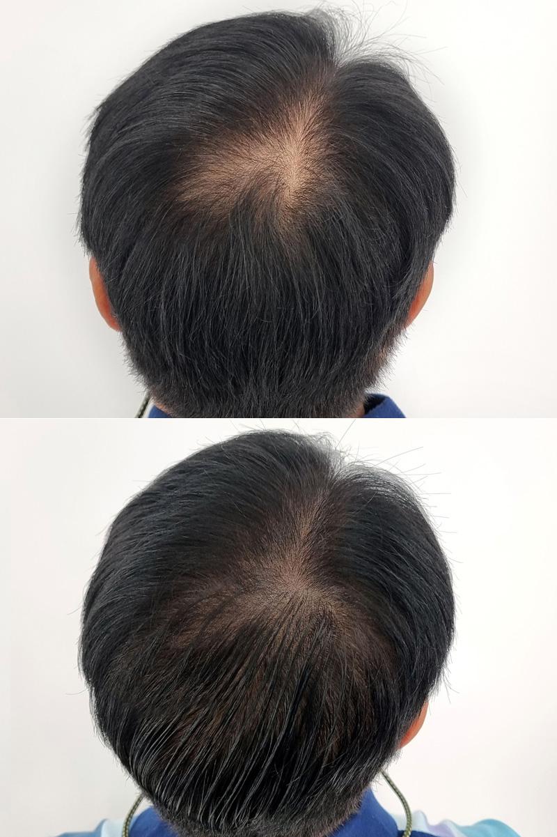 米诺为什么能治疗脱发 (脱发用米诺能治好吗)