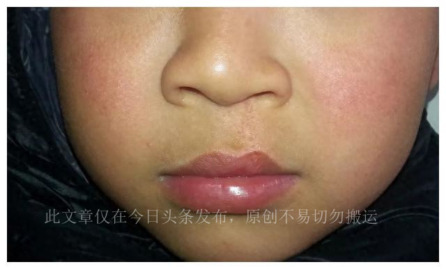 4岁孩子最近总咬指甲咬东西,孩子喜欢咬指甲咬东西