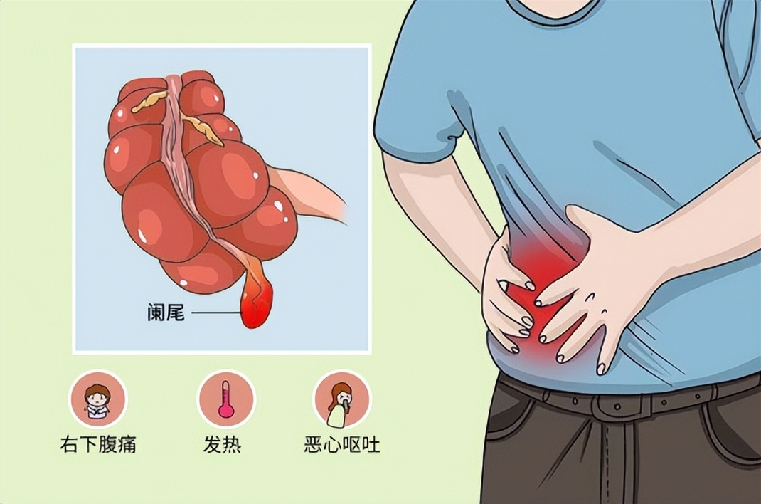 阑尾炎症状表现有哪些要做手术吗,阑尾炎的位置症状表现和治疗方法
