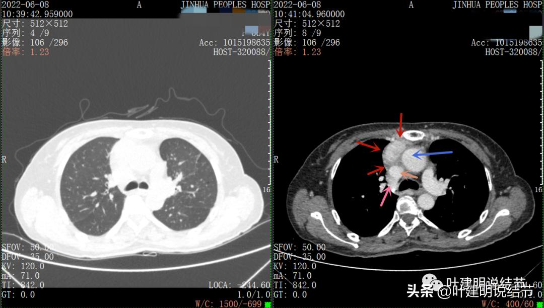 这位老乡，乏力来查，查出这么大个的纵隔肿瘤！会是什么呢？