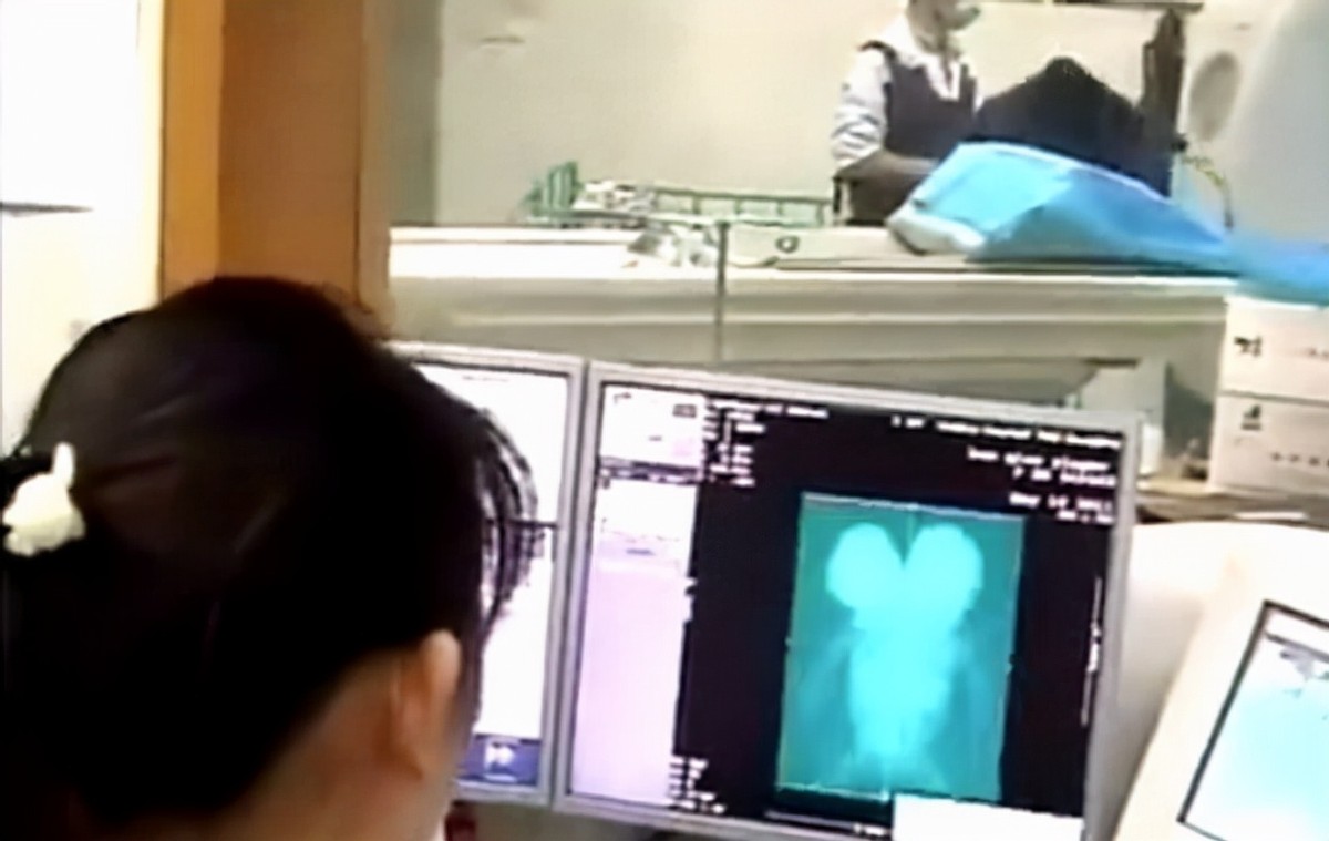 女孩去做体检发现怀了四胞胎,女子怀双胞胎竟是被遗传