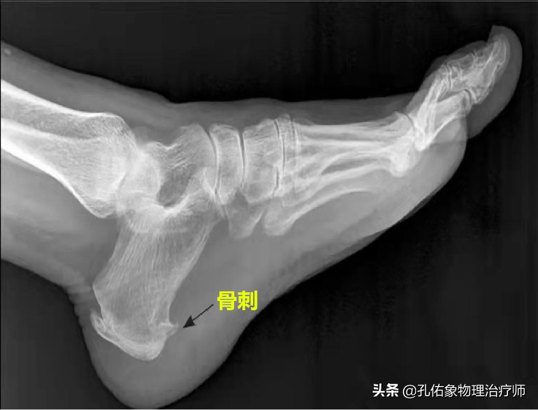 中老年人脚底痛是什么原因,老人脚底板好疼是什么原因