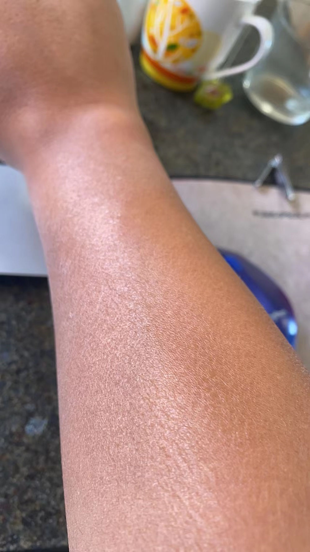 每到秋天，手和腿上就会出现各种干燥情况，还会脱皮，要怎么办？