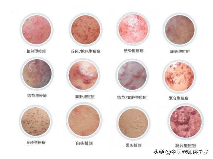 激素依赖性皮炎真相,激素依赖性皮炎的病因