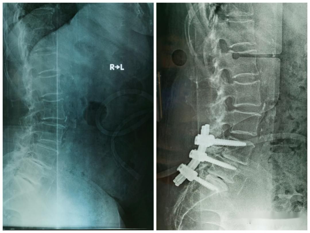 腰椎滑脱的病因,腰椎滑脱症最常见的鉴别诊断
