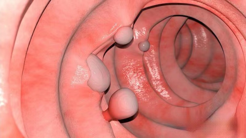 为什么会肠道长息肉,肠道容易长息肉是什么原因