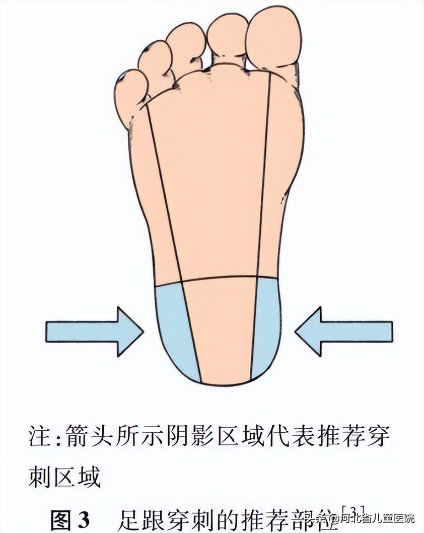 儿童静脉采血指南,婴幼儿末梢采血方法