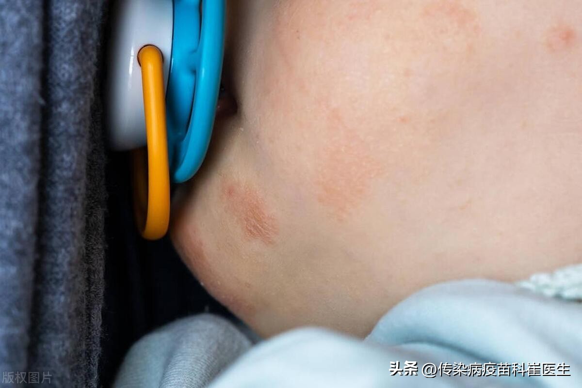 换了氨基酸奶粉宝宝还是反复湿疹,眼睛周围湿疹容易反复怎么能根除