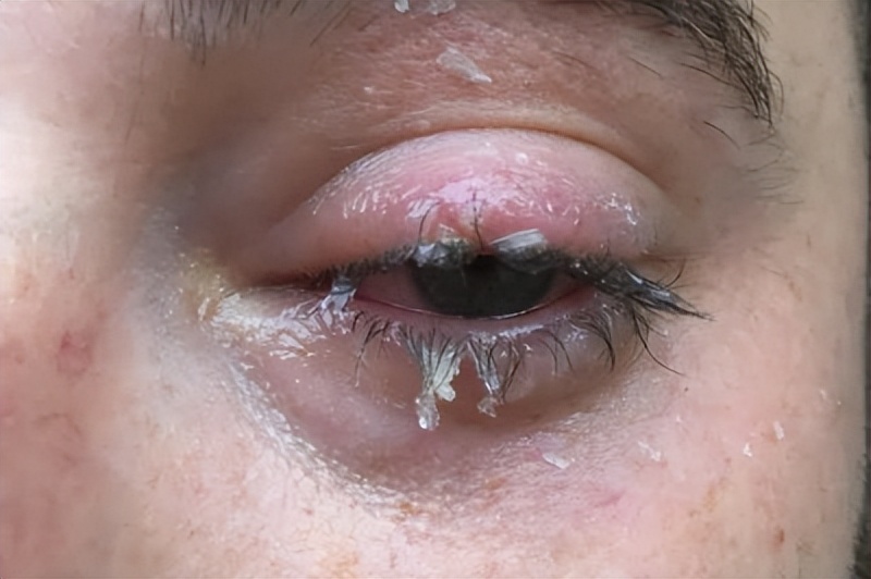 眼睛被热水溅到怎么处理,502不慎溅入眼睛要冲洗多久