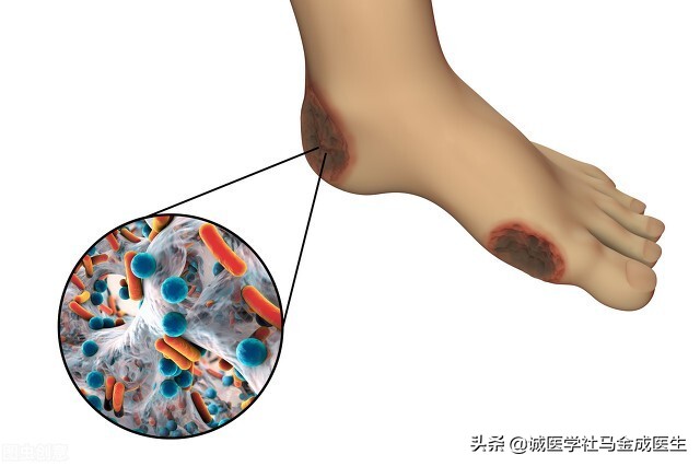 当归六黄汤治糖尿病,六味地黄汤治疗糖尿病加减