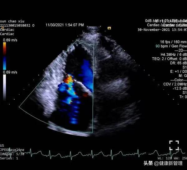 二尖瓣微创钳夹术全过程怎么做,二尖瓣微创钳夹术视频