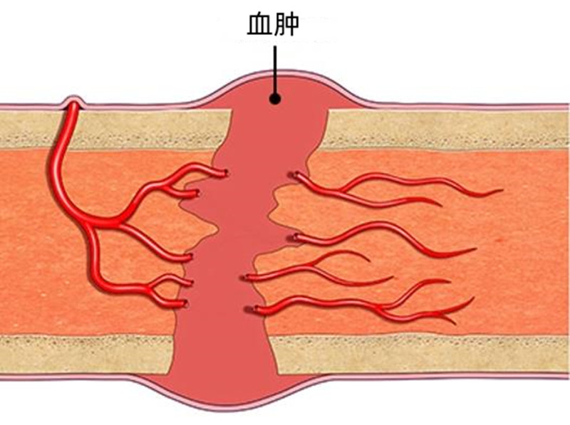 骨折后的征兆,骨折刚恢复后该注意什么