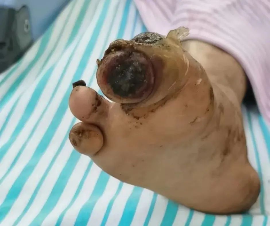 血栓引起的脚趾头坏死,脉管炎脚趾头坏死化脓