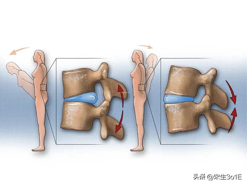 中医治疗椎间盘突出怎么治疗,温通针法治疗椎间盘突出