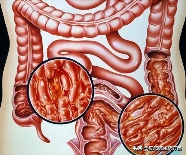注意了,溃疡性结肠炎,一旦出现这3种迹象,十有八九在癌变