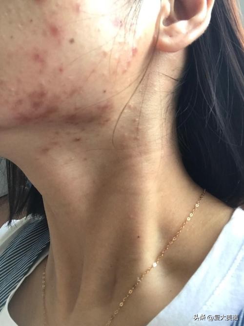 复大美诺祛斑,复大美诺多肽净颜液