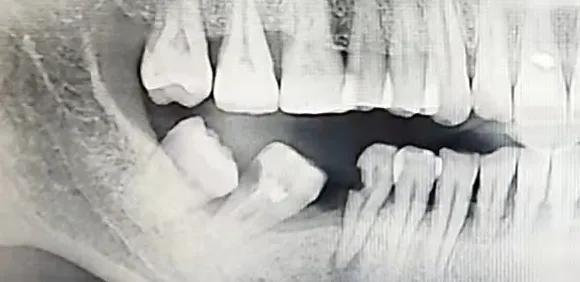 一个牙医的良心忠告种植牙,种牙戴牙冠5年后真实感受